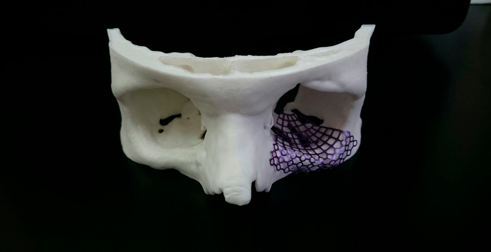 Las impresiones en 3D pueden ayudar al problema del atraso de las cirugías.